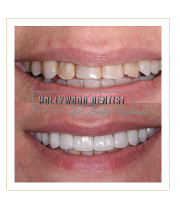 Dr. Sally teeth whitening