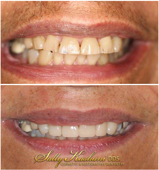 Hollywood Dental Crowns Before & After Photo